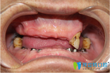 治療前口內(nèi)照