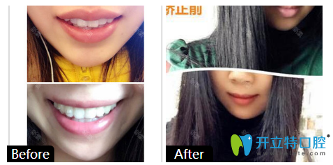 廣州柏德口腔3M金屬進口托槽矯正牙齒案例
