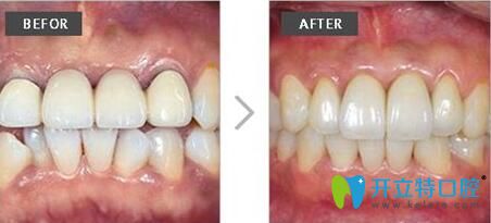 范金梅院長(zhǎng)根管治療案例