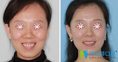 周長(zhǎng)松院長(zhǎng)牙齒正畸案例 周長(zhǎng)松院長(zhǎng)牙齒正畸案例