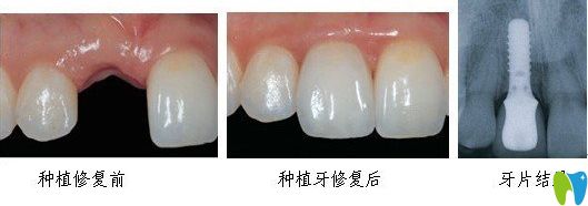 唐山拜博單顆即刻種植牙