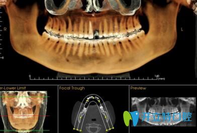 長沙美萊口腔數(shù)字化矯正專業(yè)軟件分析