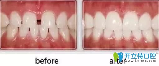 <!--<i data=20240703-sp></i>-->醫(yī)師牙齒貼面案例 <!--<i data=20240703-sp></i>-->醫(yī)師牙齒貼面案例