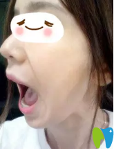 已經(jīng)三個月了我可以大張嘴了