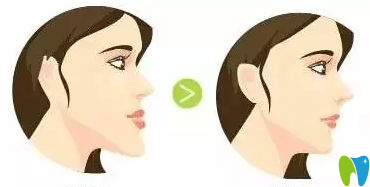 地包天如何預(yù)防？治療時間是什么時候？