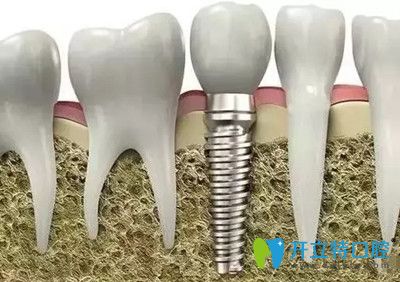 種植牙步驟 種植牙步驟