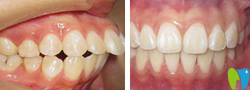 濰坊可恩口腔魏奉才上頜矯正效果對(duì)比圖