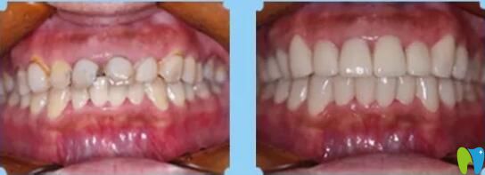 張玉秋主任牙齒咬合矯正案例 張玉秋主任牙齒咬合矯正案例