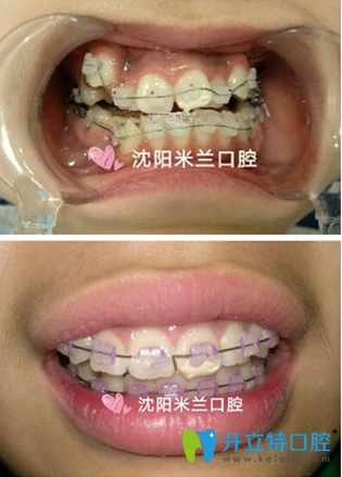 范阿丹院長牙齒矯正案例