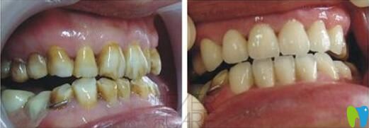 彭陽醫(yī)師仿生美學(xué)修復(fù)案例 彭陽醫(yī)師仿生美學(xué)修復(fù)案例