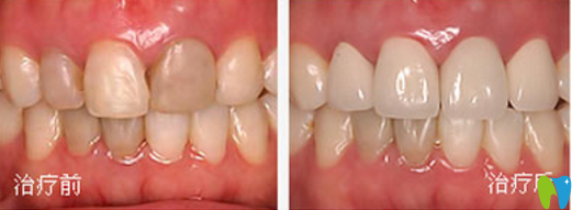 吸煙導(dǎo)致牙齒發(fā)黃？菏澤美爾口腔全瓷牙修復(fù)就能幫你改善