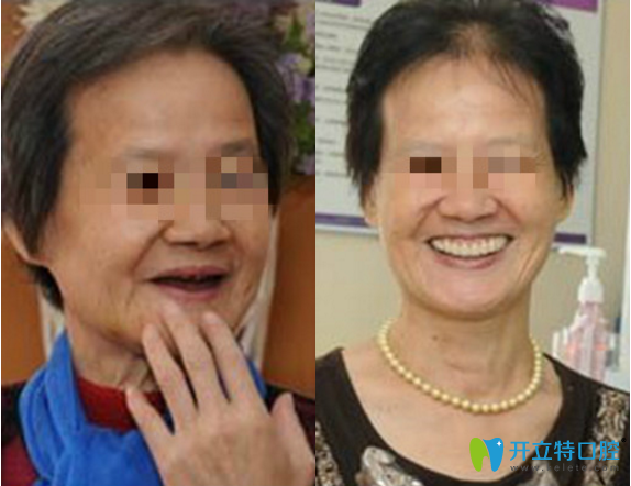 邵陽雅貝康口腔牙種植與牙美容修復(fù)真人案例