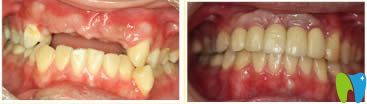 種植牙修復近照及對比效果