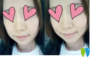 咬合完全正確后我簡直就是小仙女哈哈