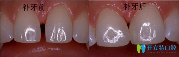 潮州眾信補(bǔ)牙真人案例效果對比 潮州眾信補(bǔ)牙真人案例效果對比