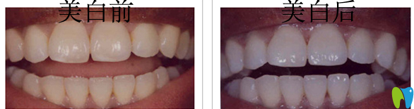 潮州眾信牙齒美白案例 潮州眾信牙齒美白案例