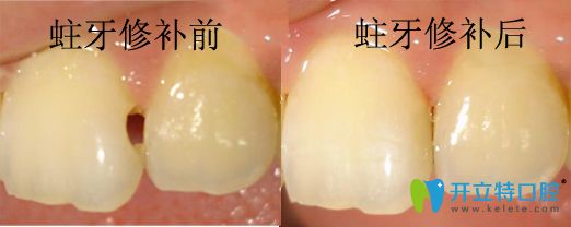 潮州眾信蛀牙修補(bǔ)前后對比 潮州眾信蛀牙修補(bǔ)前后對比