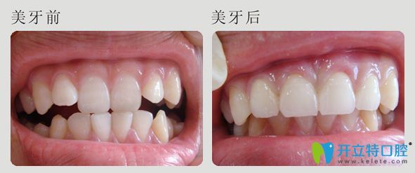 潮州眾信牙科美牙前后效果對比 潮州眾信牙科美牙前后效果對比