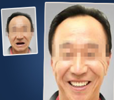 真人案例:廈門宏沅膛口腔60歲老人種植牙術(shù)前術(shù)后效果對比