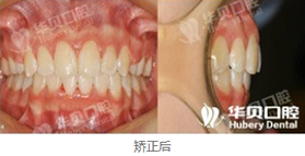 在濰坊華貝口腔做了牙齒矯正，恢復(fù)后我擺脫了齙牙妹