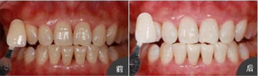 長(zhǎng)沙半島口腔楊俊為我做的牙齒美白，讓牙齒輕松變白