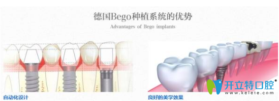 榆林長虹口德國種植牙系統(tǒng)優(yōu)勢