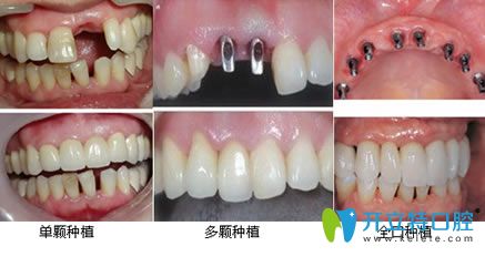 長(zhǎng)春現(xiàn)代口腔種植牙案例