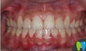 <!--<i data=20240703-sp></i>-->口腔張瓊牙齒矯正真人案例術后照