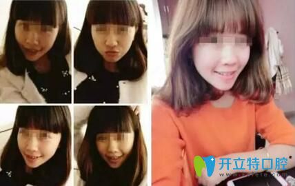 齙牙妹在康美口腔做牙齒矯正后 齙牙妹在康美口腔做牙齒矯正后