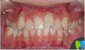 <!--<i data=20240703-sp></i>-->口腔張瓊牙齒矯正真人案例術前照