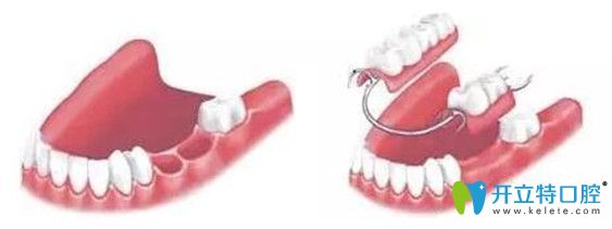 牙列缺失修復(fù)方法 牙列缺失修復(fù)方法