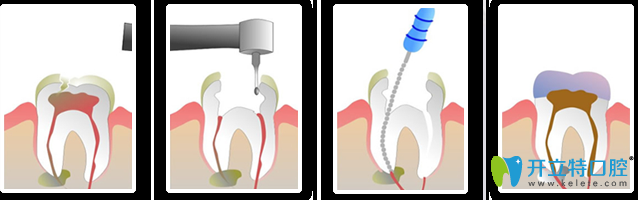 根管治療的過(guò)程