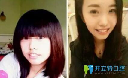 康美口腔牙齒矯正案例前后 康美口腔牙齒矯正案例前后