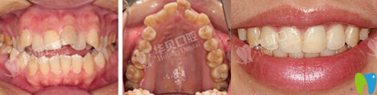 華貝口腔牙齒矯正術(shù)前術(shù)后效果圖