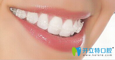 陶瓷半隱形矯治