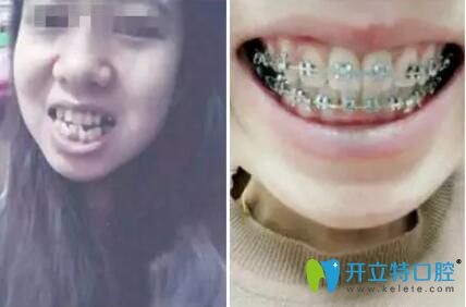 顧客在康美口腔做牙齒矯正 顧客在康美口腔做牙齒矯正