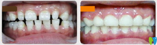 牙列稀疏前后對(duì)比