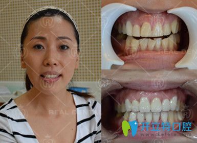 3D全瓷牙冠修復(fù)真人案例 3D全瓷牙冠修復(fù)真人案例