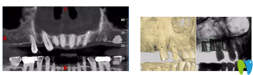 術(shù)前種植牙CT拍攝