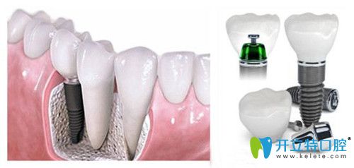 傳統(tǒng)種牙術(shù) 傳統(tǒng)種牙術(shù)