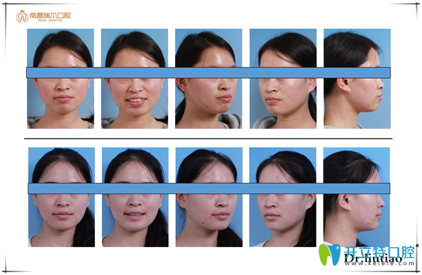 尖牙阻生，前突