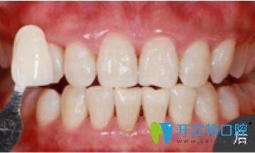 <!--<i data=20240703-sp></i>-->口腔美容冷光牙齒美白真人案例術(shù)后照