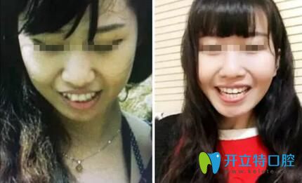 康美口腔牙齒矯正手術(shù)效果 康美口腔牙齒矯正手術(shù)效果