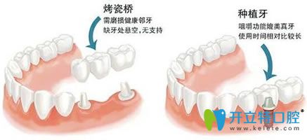 種植牙和鑲牙哪個(gè)壽命更長(zhǎng)