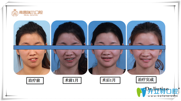 中線不齊伴前突真人案例 中線不齊伴前突真人案例