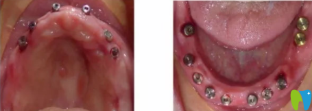 60歲老人在宏沅膛口腔做滿口牙種植手術(shù)中