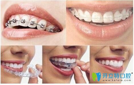 欽州康美口腔正畸拔牙:三類人必須拔 五類人不能拔