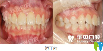濰坊華貝口腔牙齒矯正前