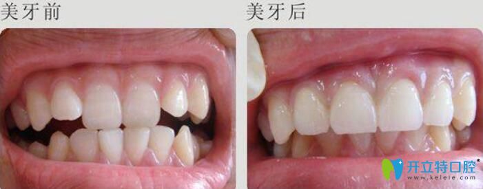 慕林林德國3D美牙冠案例