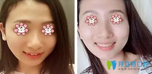 權(quán)花淑牙齒咬合矯正案例 權(quán)花淑牙齒咬合矯正案例